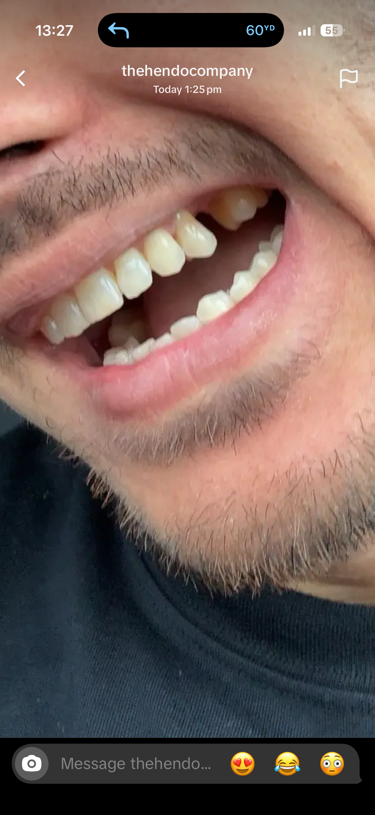 Diamonds missing tooth & cap