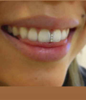 Diamond Gap filler/ Strip Design