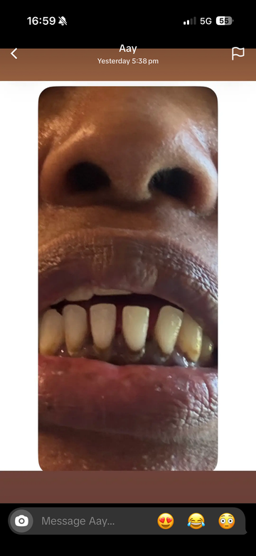 Triple gap filler