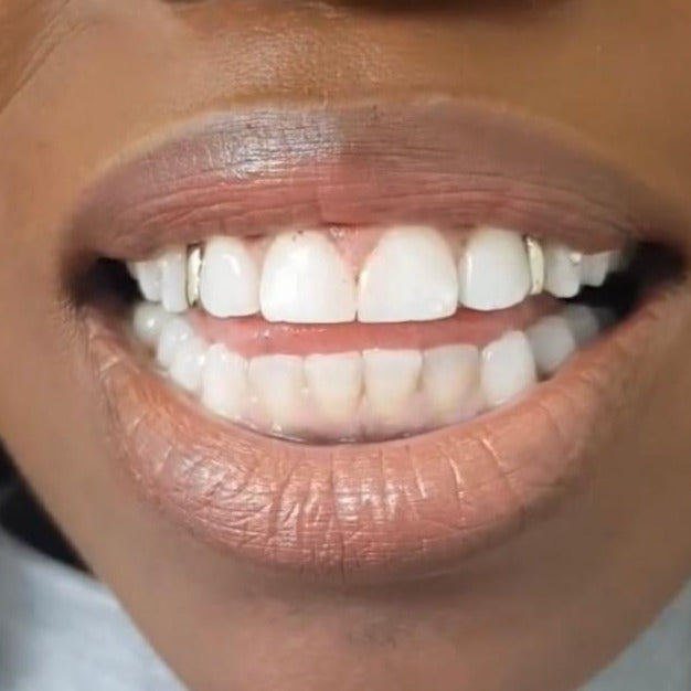 Gap filler, Gold Strip Design