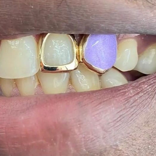 Enamel cap *Any colour* and Window set